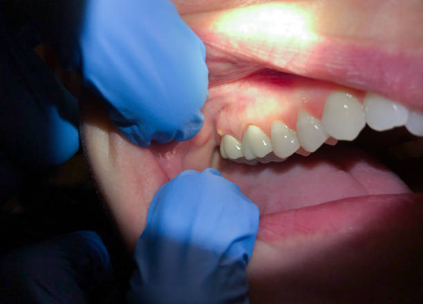 Best Emergency Treatment for Toothache in Fussels Corner, FL